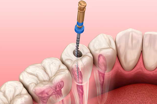 Cuáles son los casos para realizar una endodoncia